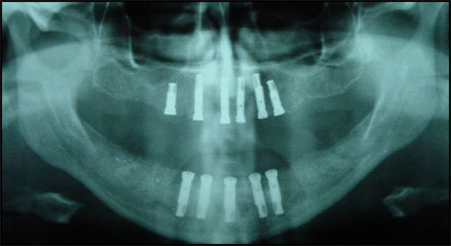 Panoramic radiograph of implants in upper and lower jaws