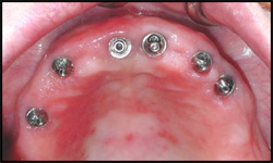 implants in upper jaw
