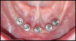 implants in lower jaw