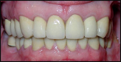 Same teeth after treatment.